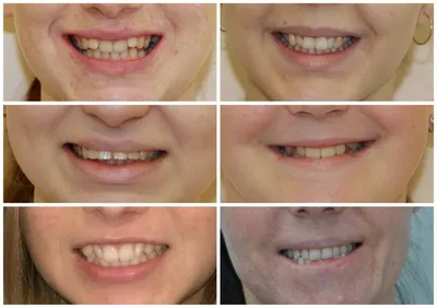 Десневая улыбка. Методы коррекции. Пример коррекции десневой улыбки  Ботоксом (Botox).