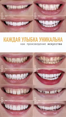 Идеальная улыбка - фото, стоматология, как сделать, сколько стоит.