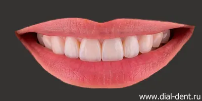 Ширина улыбки — О брекетах от ортодонта