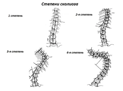 Что такое доска Евминова? Как это лечит сколиоз?