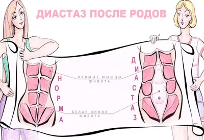 Диастаз - признаки и причины