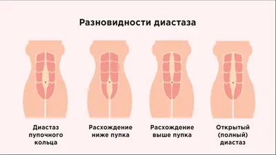 Диастаз - как быстро справится? А так же что это такое? Какие тренировки  допустимы при диастазе? | Диетолог Николай Тихенко | Дзен