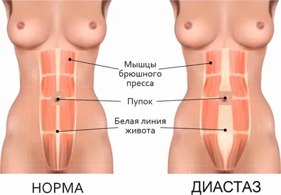 Операция по ушиванию диастаза (обтурационная герниопластика) - «Через  маленький разрез в пупке ушили мой огромный диастаз. Подробный отчет о  реабилитации. Как сделать эту операцию бесплатно» | отзывы