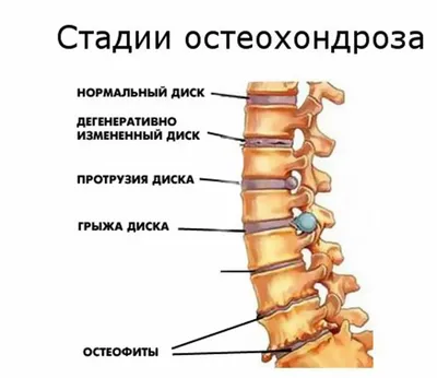 Упражнения при шейном остеохондрозе - Найз Гель