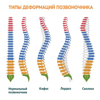 Остеохондроз: что это, причины, симптомы, признаки, лечение, профилактика,  диагностика