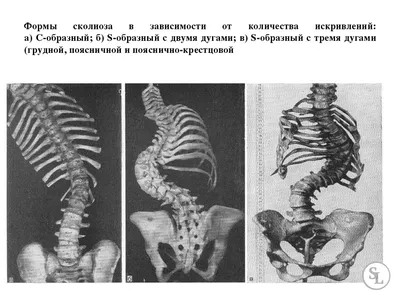 Защемление седалищного нерва (Ишиалгия) - Vertebra