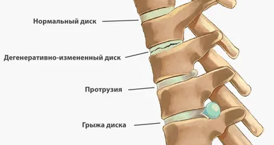 Комплекс упражнений при шейном остеохондрозе | Массаж.ру