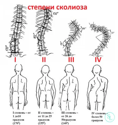 S-Образный сколиоз 1-2-3 степени, причины, лечение грудо-поясничного отдела  позвоночника