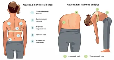 Сколиоз: этиология, классификация, диагностика, лечение - Vertebra