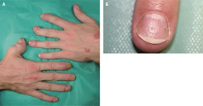 Фотография утолщения суставов пальцев рук