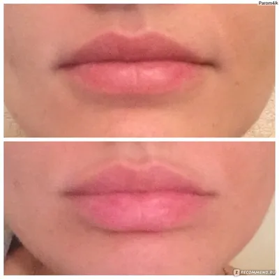 Фото до и после увеличения губ на 0,5 мл