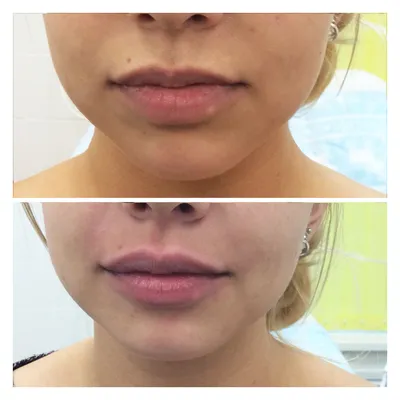 Фото до и после процедуры увеличения губ на 0,5 мл