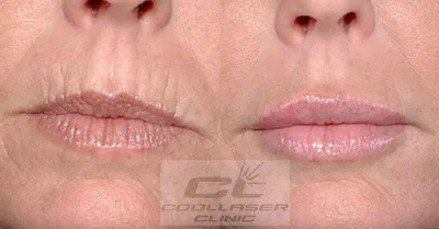 Фотоэффект увеличения губ на полмиллилитра