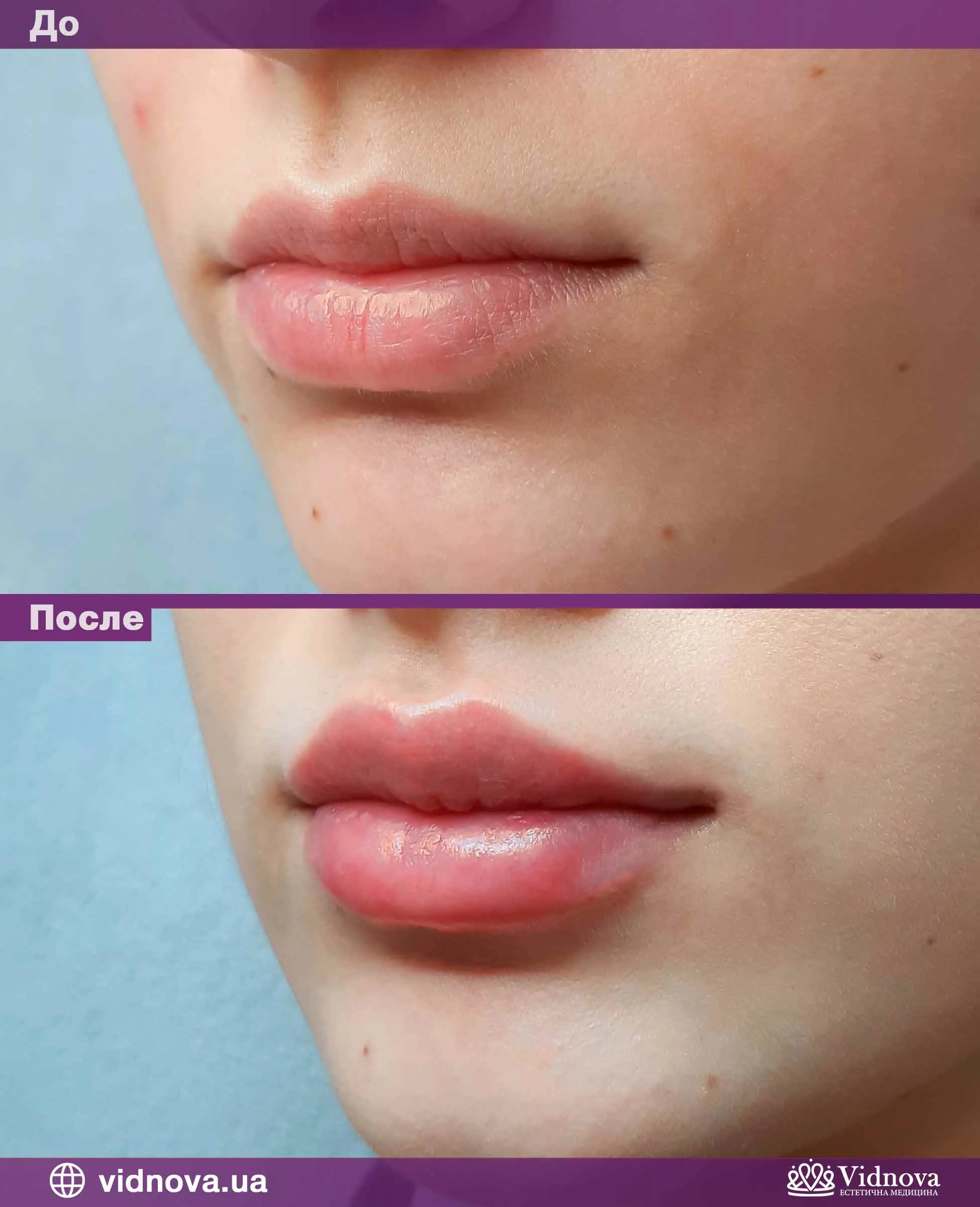 Натуральное увеличение губ до и после фото