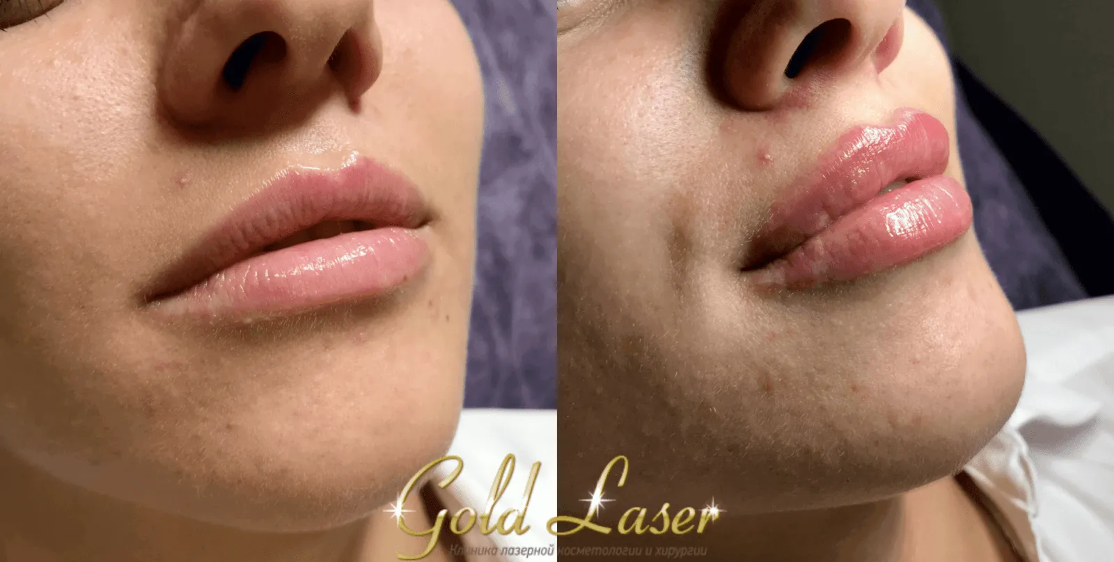 Увеличение губ мужчинам фото до и после