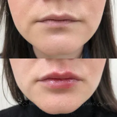 Фото до и после увеличения губ на полмиллиметра