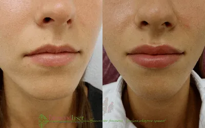 Фото, демонстрирующее видимые изменения после увеличения губ на 0,5 мл