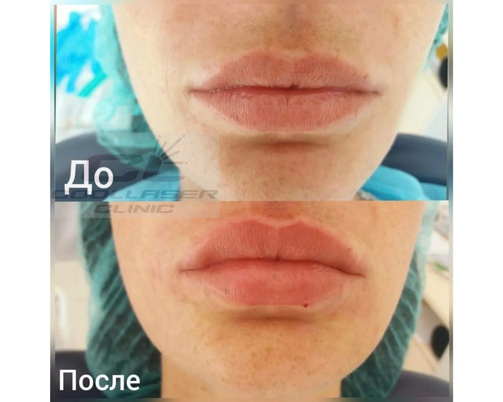 неудачное увеличение губ фото до и после