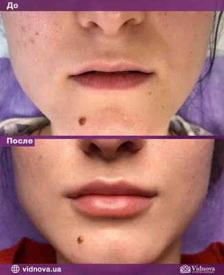 Красота в деталях: фото увеличения губ на 0,5 мл до и после