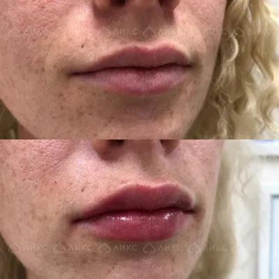 Изменение формы губ: фотоэффект до и после процедуры