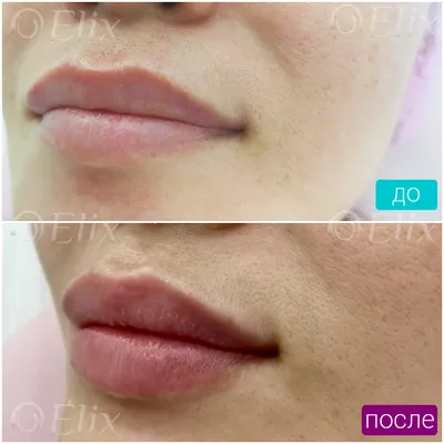 Увеличение губ на 0,5 мл: фото до и после