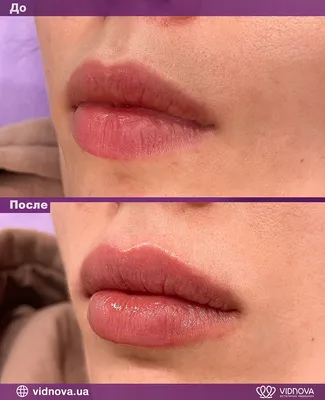 Красота в деталях: фотоэффект увеличения губ на 0,5 мл до и после
