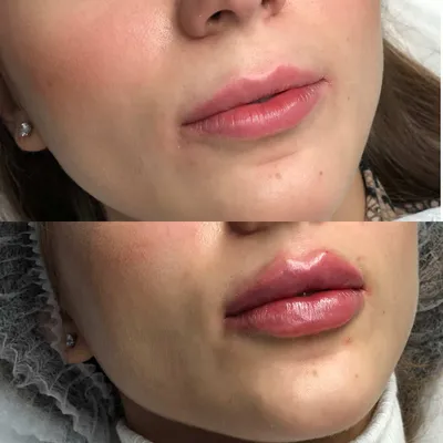 Изменение формы губ: фото увеличения губ на 0,5 мл до и после