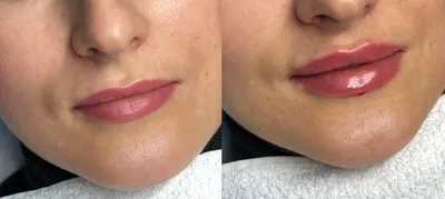 Фото красоты: увеличение губ на 0,5 мл до и после процедуры