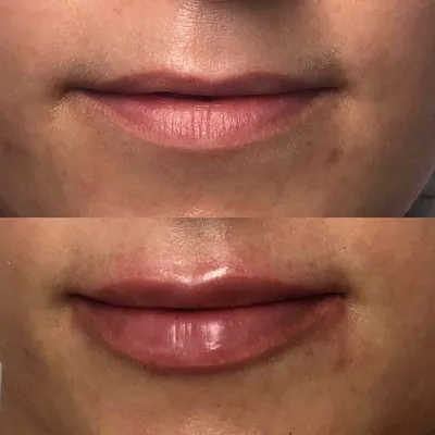 Фото преображения: увеличение губ до и после процедуры на 0,5 мл