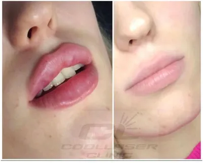 Фото увеличения губ на 0,5 мл: до и после