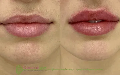Как выглядят губы после увеличения на 0,5 мл: фото