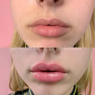 Фото увеличенных губ: как сделать, чтобы они выглядели естественно