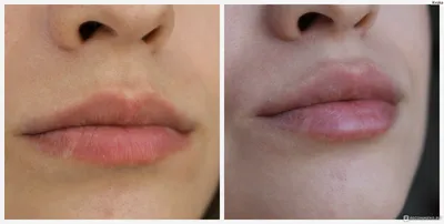 Увеличение губ на фотографии: с чего начать