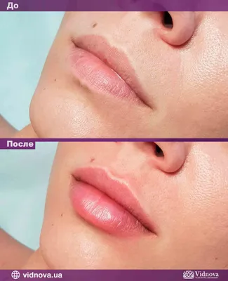 Как правильно обработать фото с увеличенными губами