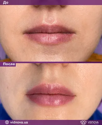 Фото увеличенных губ: как сделать, чтобы они выглядели естественно на селфи