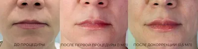 Изображение процесса увеличения губ