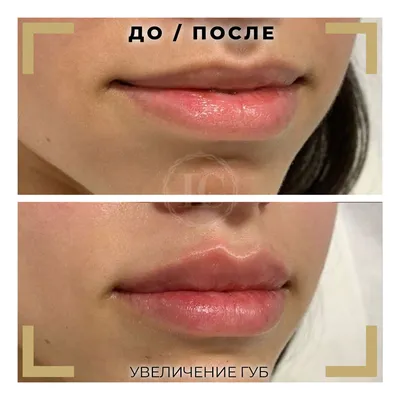 Фотография губ после процедуры увеличения