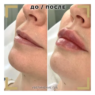 Фото увеличенных губ: перед и после