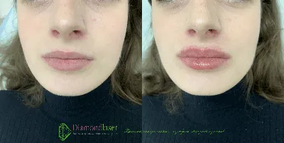 Фотография губ после процедуры увеличения на 0,5 мл