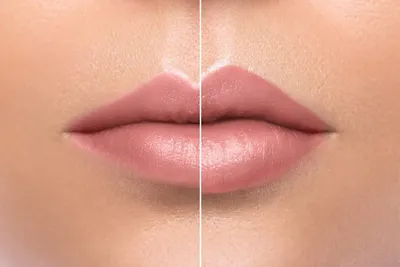 Фото губ до и после увеличения на 0,5 мл: как выбрать правильный объем