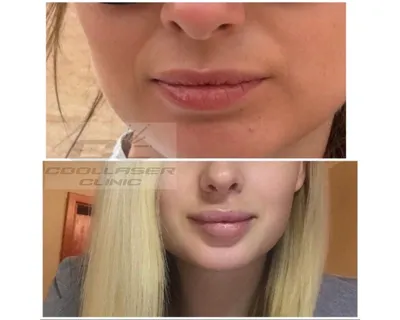 Фотография с результатом увеличения губ