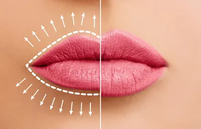 Фотоэффект увеличения губ: какие методы бывают