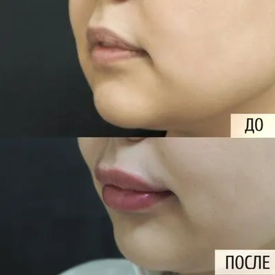 Натуральный и объемный результат увеличения губ