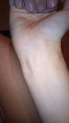 Фотки варикоза рук: как лечить болезнь
