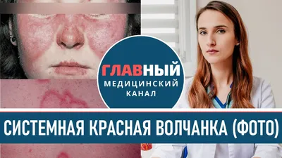 Изображение Васкулита на руках: PNG формат