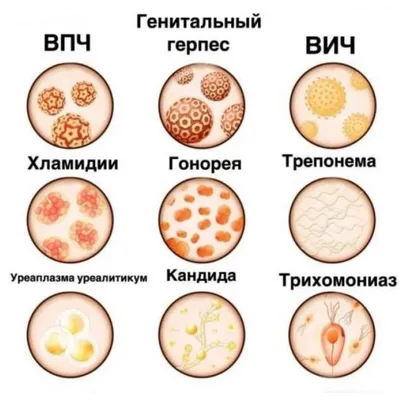 Венерические заболевания в картинках фотографии