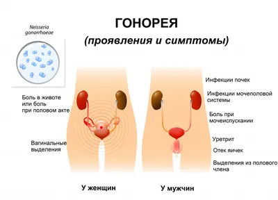 Гонорея - причины появления, симптомы заболевания, диагностика и способы  лечения