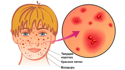 Что нужно знать родителям о том, как проходит ветрянка у детей