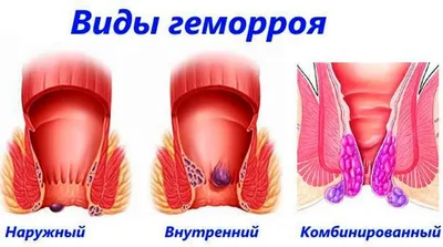 Геморрой! Деликатная проблема | 1000 и один совет | Дзен