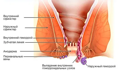 Виды геморроя в картинках